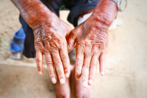Skin disorder, pepper appearance from scleroderma, autoimmune disease male hand