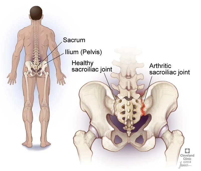 Ankylosing Spondylitis As Los Angeles Pacific Arthritis Care Center